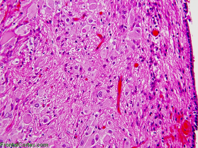 Subependymal giant cell astrocytoma x200